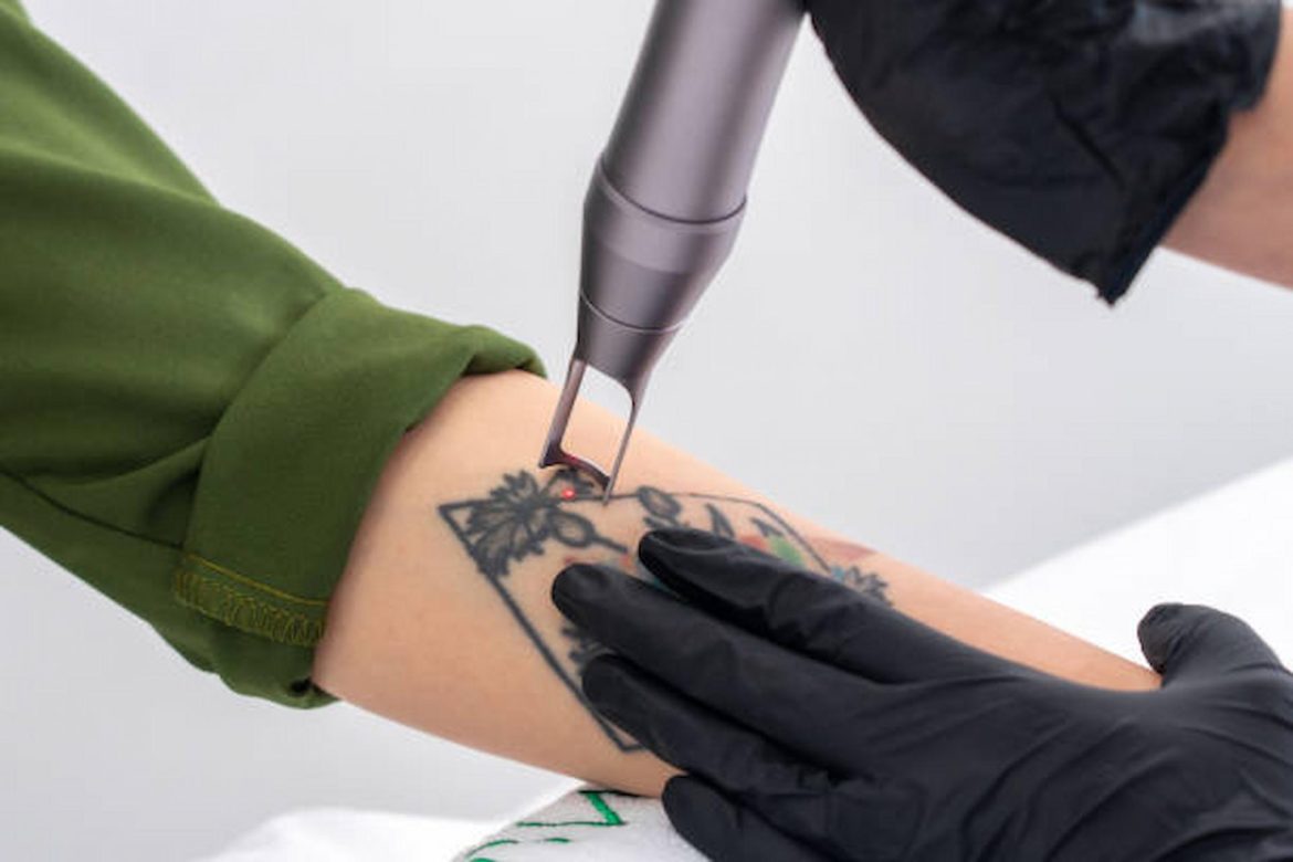 How To Find An Expert Tattoo Removal Service Provider In London?