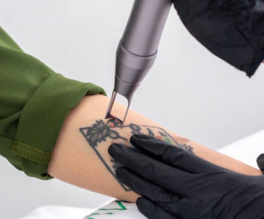 How To Find An Expert Tattoo Removal Service Provider In London?