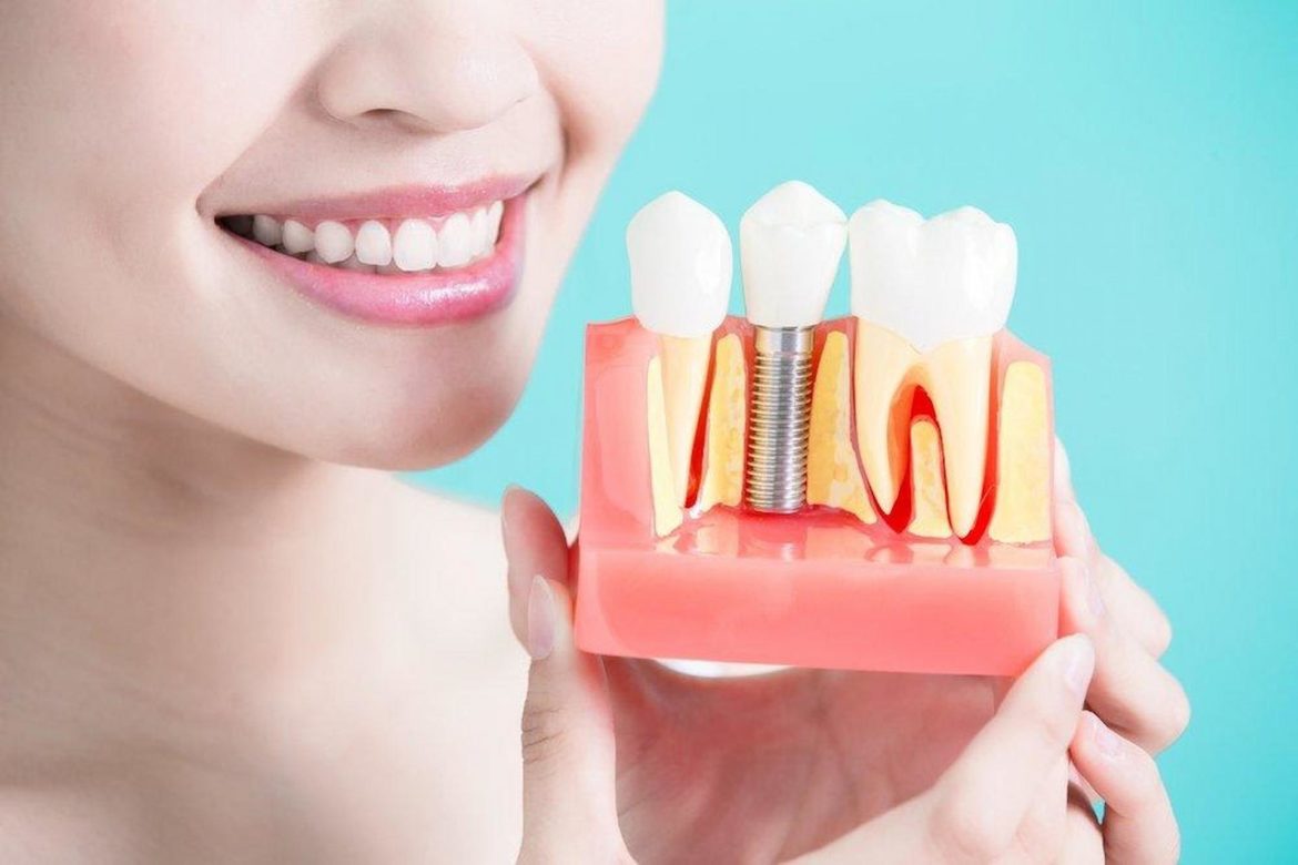 How To Know When You Need A Dental Implant?